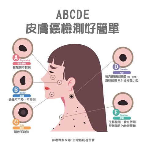 臉 長痣|皮膚長痣、長斑是皮膚癌前兆？皮膚癌初期4大症狀快。